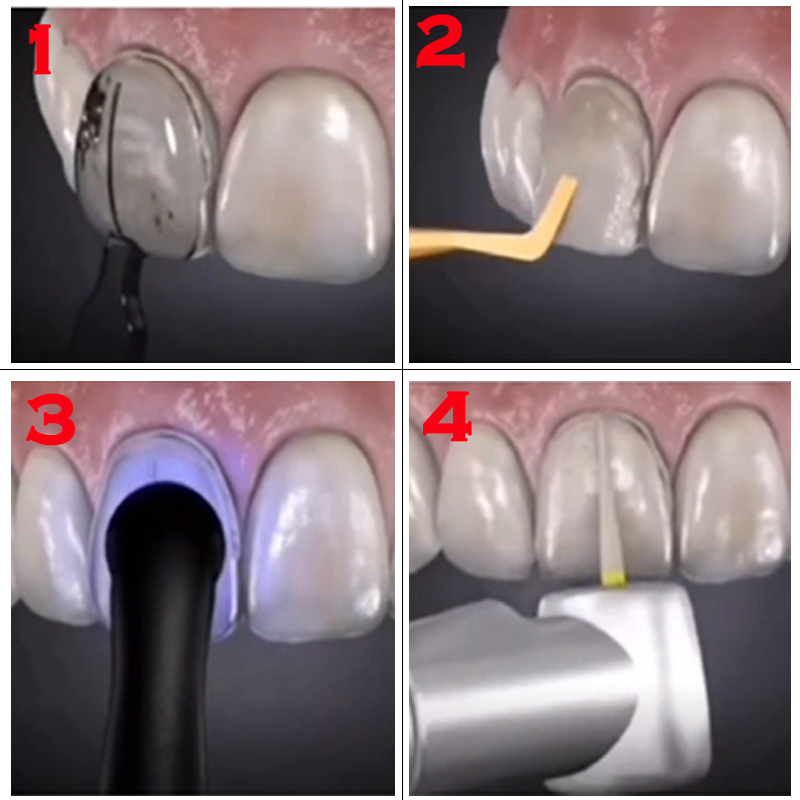 32-częściowy zestaw do wybiela – Teeth Whitening Moulds recenzja i cena