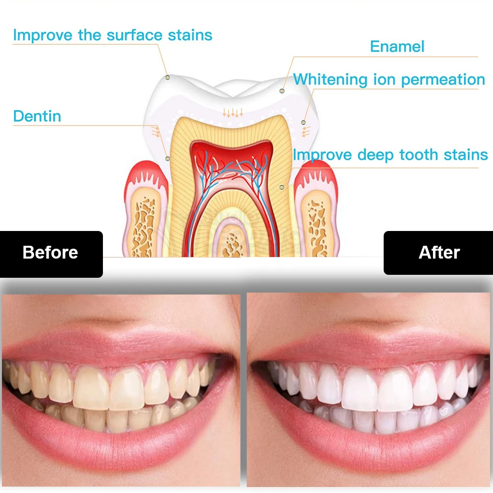 Zestaw do wybielania zębów den – Teeth Whitening Near Me recenzja i cena